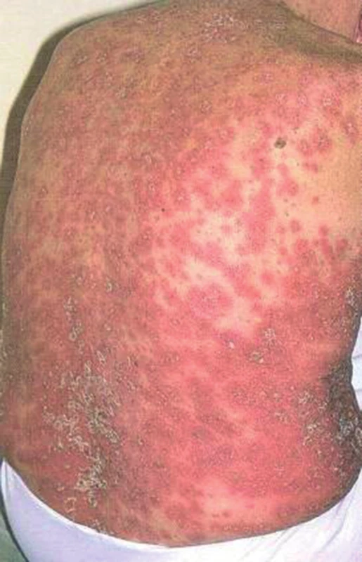Generalizovaná pustulózní psoriáza