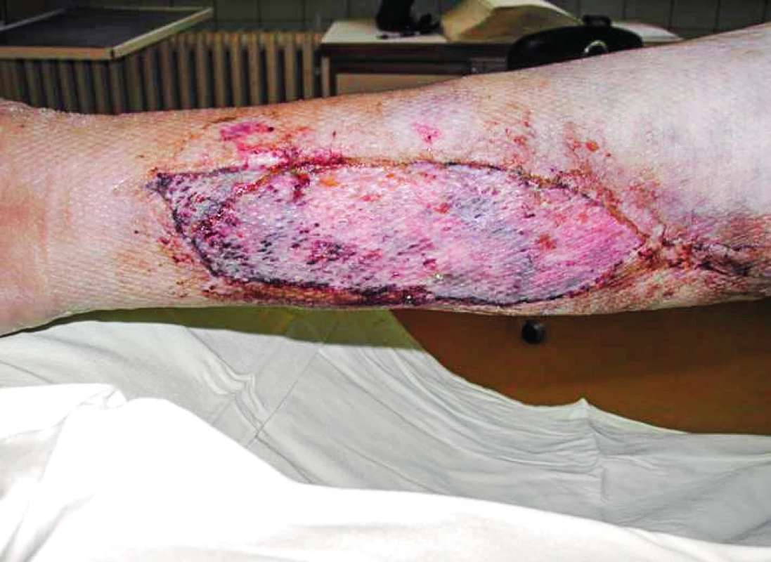 Healed wound 12 days after wound closure by splitthickness skin autograft. Softened skin margins with no oedema enabled partial suture proximally