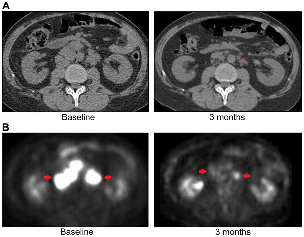 Anti-tumor activity of Patient 3, harboring an <i>ERRFI1</i> mutation, to erlotinib, an EGFR inhibitor.