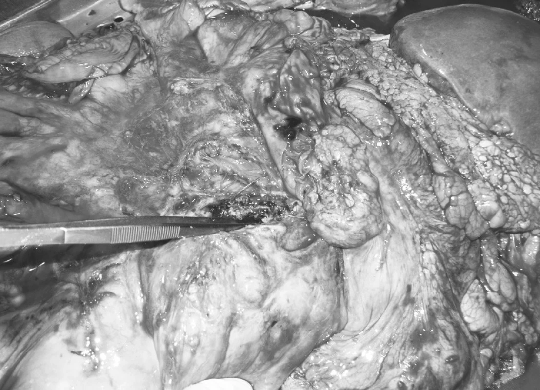 Nález recidivující aorto-enterální píštěle při pitvě
Pic. 1. An autopsy finding of a relapsing aortoenteral fistula