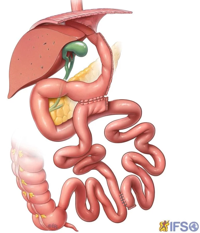 Sleeve resekce + transit bipartition (Santoro 2012)    Fig. 1: Sleeve resection + transit bipartition (Santoro 2012)