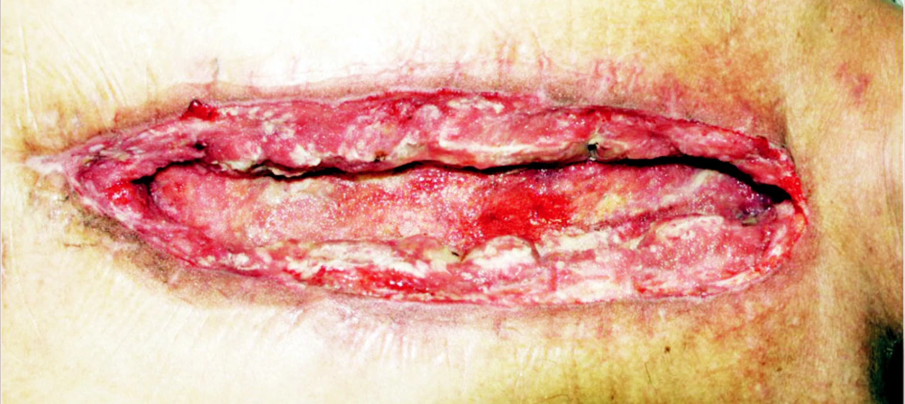 Výsledný stav podtlakové terapie
Fig. 5. Deep sternal infection. The result of the VAC therapy