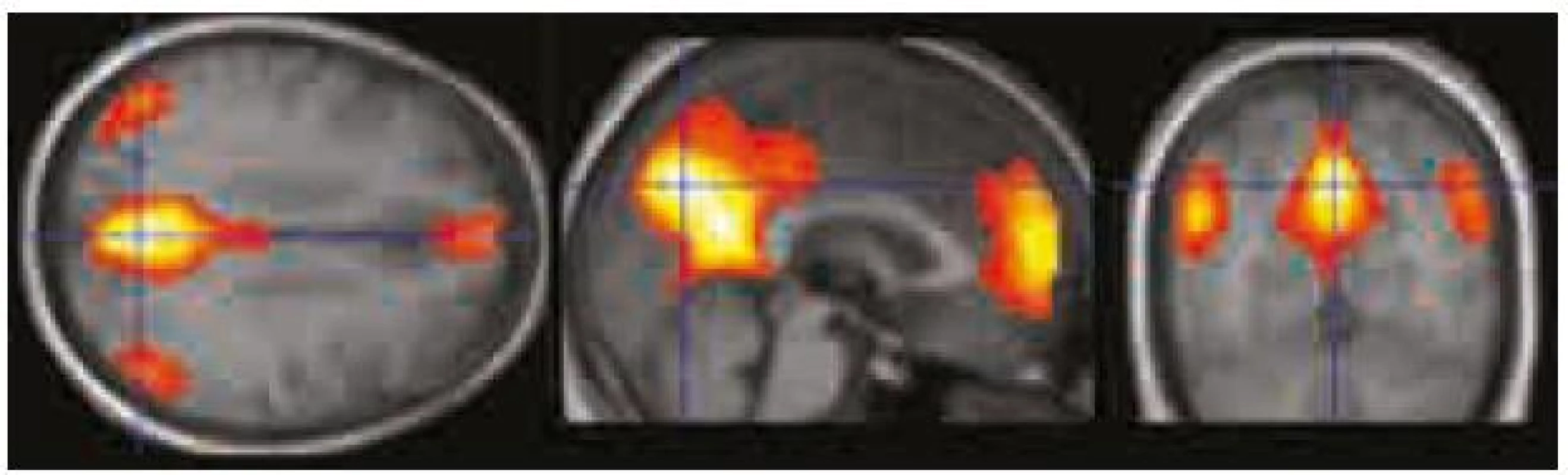 Zobrazení „resting state“ sítě vycházející z ICA analýzy klidových fMR dat. Zobrazeno při p < 0,0001 nekorigovaně.
Hlavními oblastmi zapojenými do DMS s největší intenzitou signálu (barvy blížící se žluté/bíle) jsou zadní cingulum/precuneus, ventromediální prefrontální kortex/přední cingulum a gyrus angularis/lobulus parietalis inferior bilaterálně.