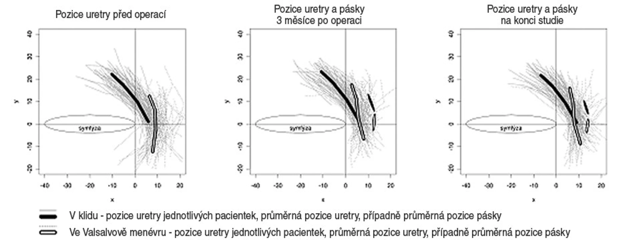 Změny uložení uretry vyvolané operací a v průběhu sledování a změny v uložení a mobilitě pásky v průběhu sledování