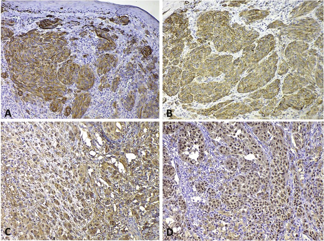 Pozitivita rutinně používaných imunohistochemických biomarkerů v buňkách melanomu A – HMB45 s cytoplazmatickou pozitivitou; B – MelanA/MART-1 s cytoplazmatickou pozitivitou; C – S100 – cytoplazmatická i jaderná pozitivita; D – MiTF – jaderná pozitivita.