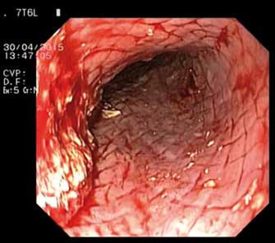 Jícen po extrakci stentu – endoskopický pohled.
Fig. 4. Oesophagus after stent extraction – endoscopic image.
