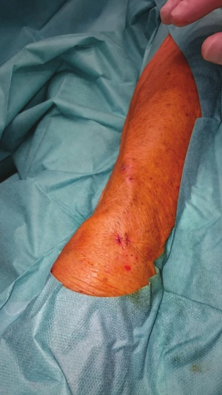 Výsledný stav na předloktí ihned po výkonu
Fig. 8: Final outcome in the forearm immediately after the procedure