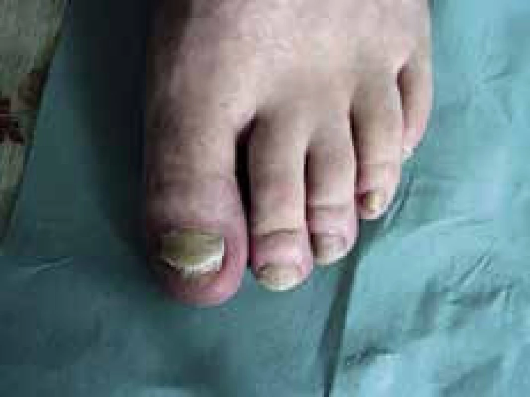Onychomycosis candidomytetica