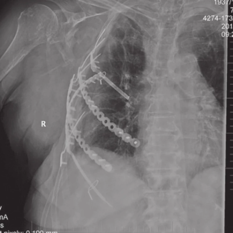 Snímek po stabilizaci
Fig. 2: X-ray after stabilization