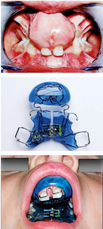 A, B, C. Temporary teeth of the patient at the age of three years (A), palate plate with a screw for transversal expansion of lateral jaw segments and elastic segment that blocks the movement of premaxilla caudally (B). Appliance in the mouth of the patient (C)