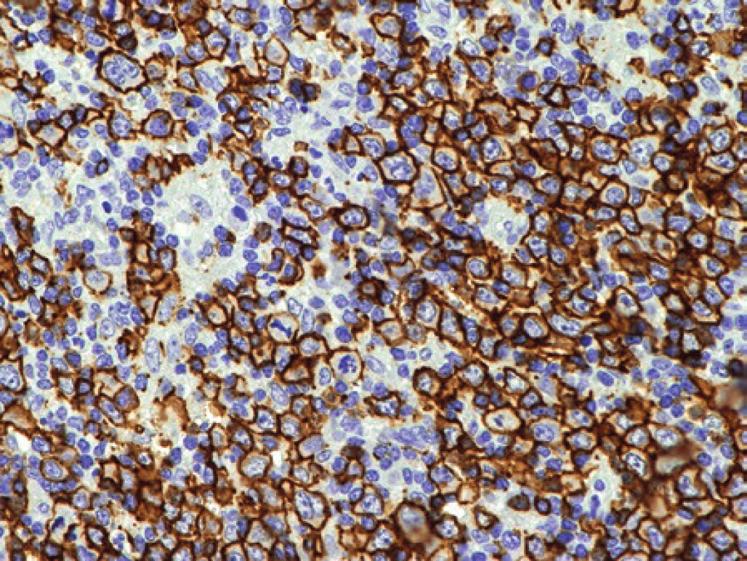 Pacientka 4. Pozitivita molekuly CD20. Za zdůraznění stojí vysoká mitotická aktivita patrná i v tomto úzkém zorném poli. Imunohistochemická reakce, dobarveno hematoxylinem (původní zvětšení 200x).