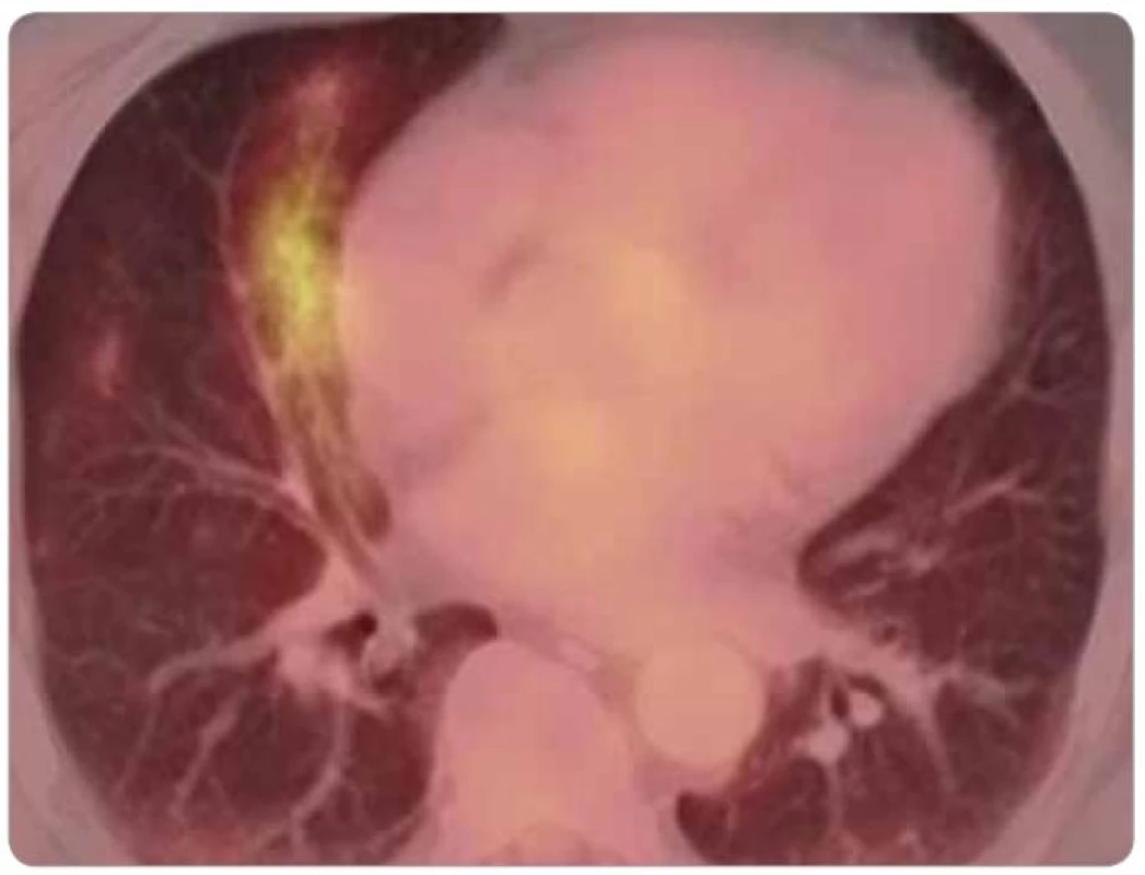 FDG-PET/CT u pacienta s dušností a kašlem po chemoterapii BEP, klinický průběh odpovídal pneumonitidě indukované bleomycinem.