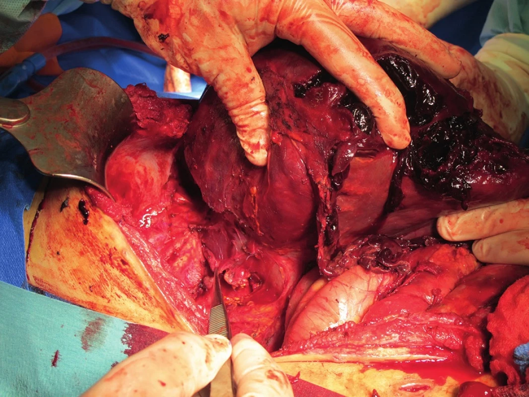 Pravostranná hemihepatektomie – peroperační obraz
Fig. 3. Right-sided hemihepatectomy – perioperative photograph