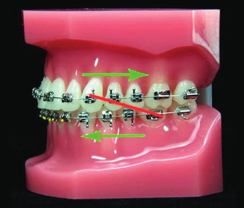Intermaxilární tahy II. třídy a směr jejich působení (https://tdrortho.wordpress.com)