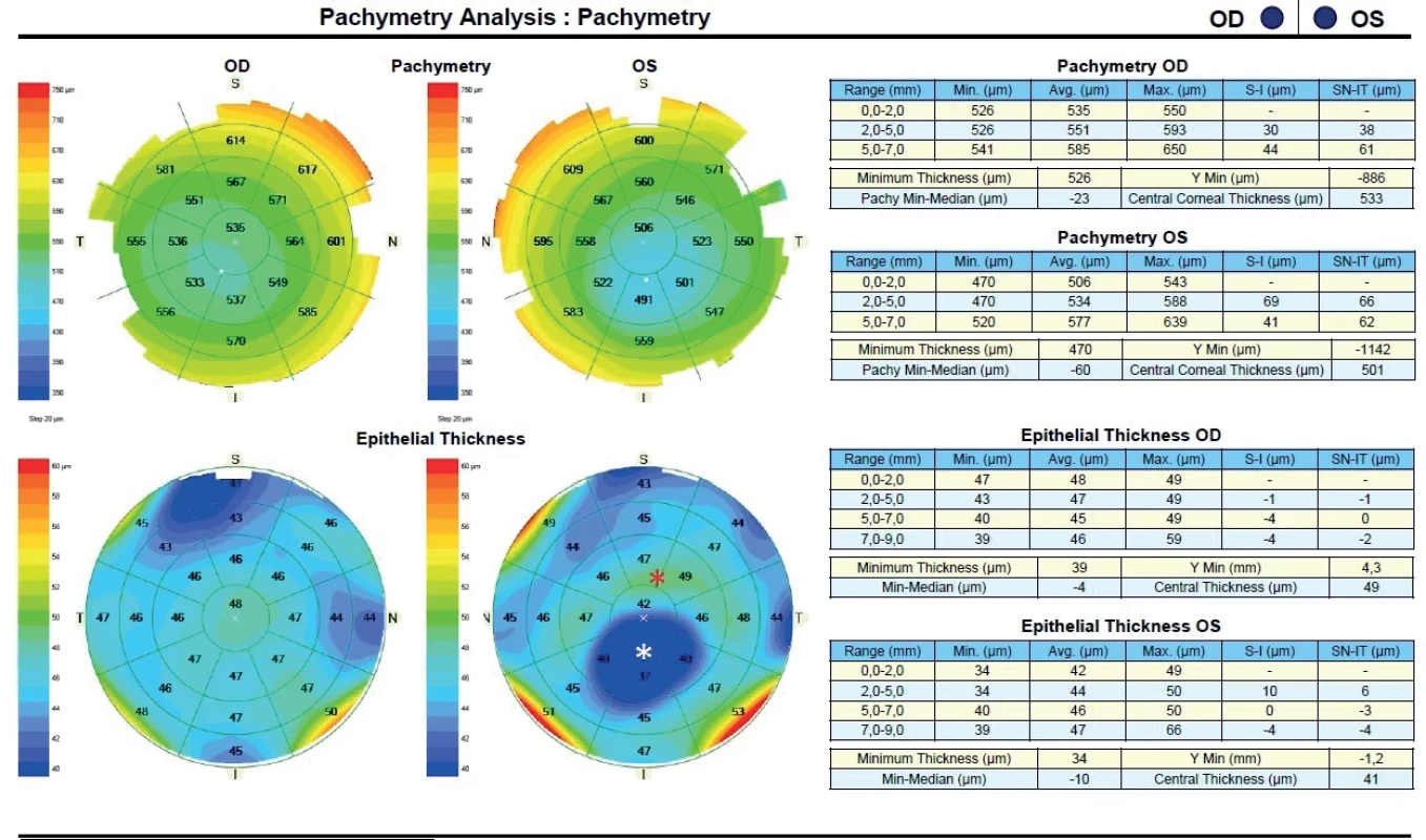 OCT Pachymetry of keratoconus – latent in the right eye and clinically manifested in the left eye. White asterisk epithelial thinning on the apex of the cone, red asterisk – epithelial thickening near the base of the cone