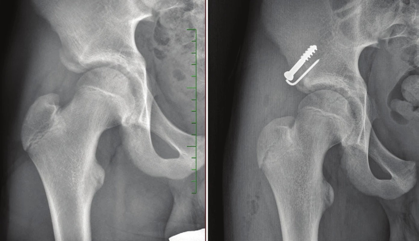 a – Úrazový RTG snímek pacienta s avulzí spina iliaca anterior inferior, b – RTG snímek jeden rok po otevřené repozici a osteosyntéze tahovým šroubem
Fig. 3: a – X-ray of a patient with avulsion fracture of the anterior inferior iliac spine; b – X-ray one year after open reduction an internal fixation with screw