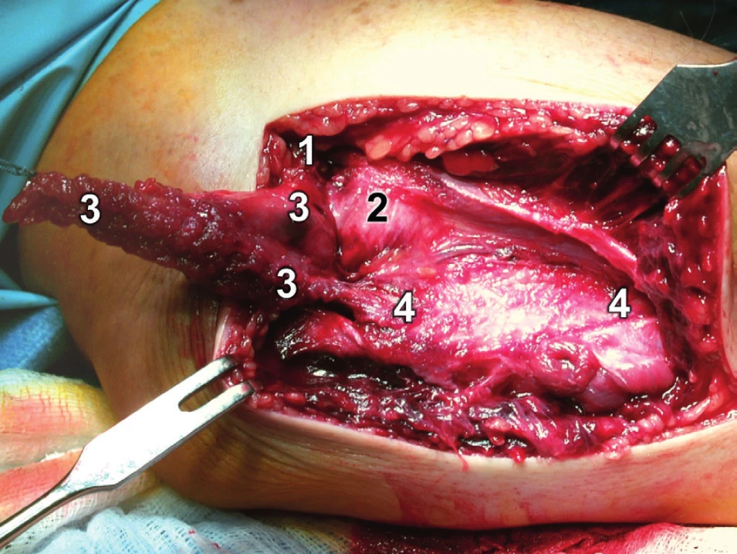 Rozšířený modifikovaný Kocherův přístup – odklopení m. anconeus proximálně: 
1 – epicondylus lateralis humeri, 2 – kloubní pouzdro, 3 – anconeus, 4 – ulna.
Fig. 15: Extended modified Kocher approach – retraction of the anconeus proximally: 1 – lateral epicondyle of humerus, 2 – joint capsule, 3 – anconeus, 4 – ulna.
