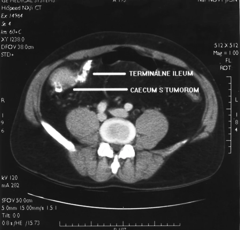 CT nález tumoru céka
Pic. 1. A CT finding of the caecal tumor