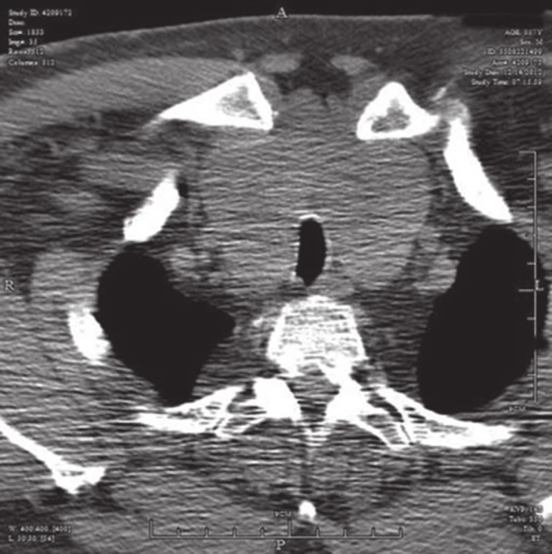 CT: objemná retrosternálně zasahující struma
Fig. 2: CT: a large goitre extending retrosternally