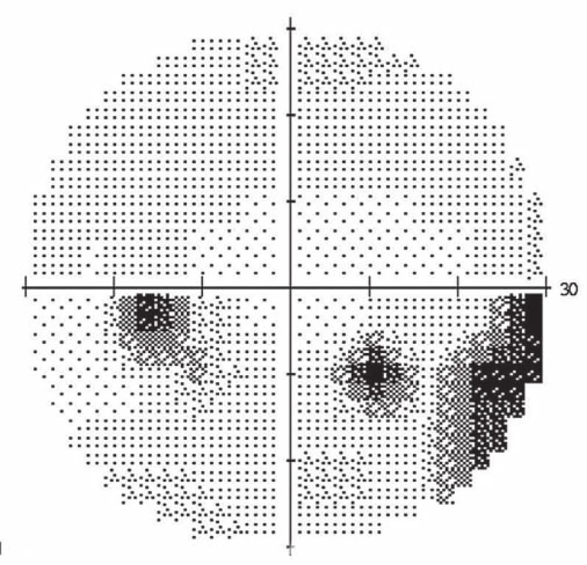 Perimeter of the left eye: altitudinal scotoma in the upper half and relative defects in the lower half of the visual field.