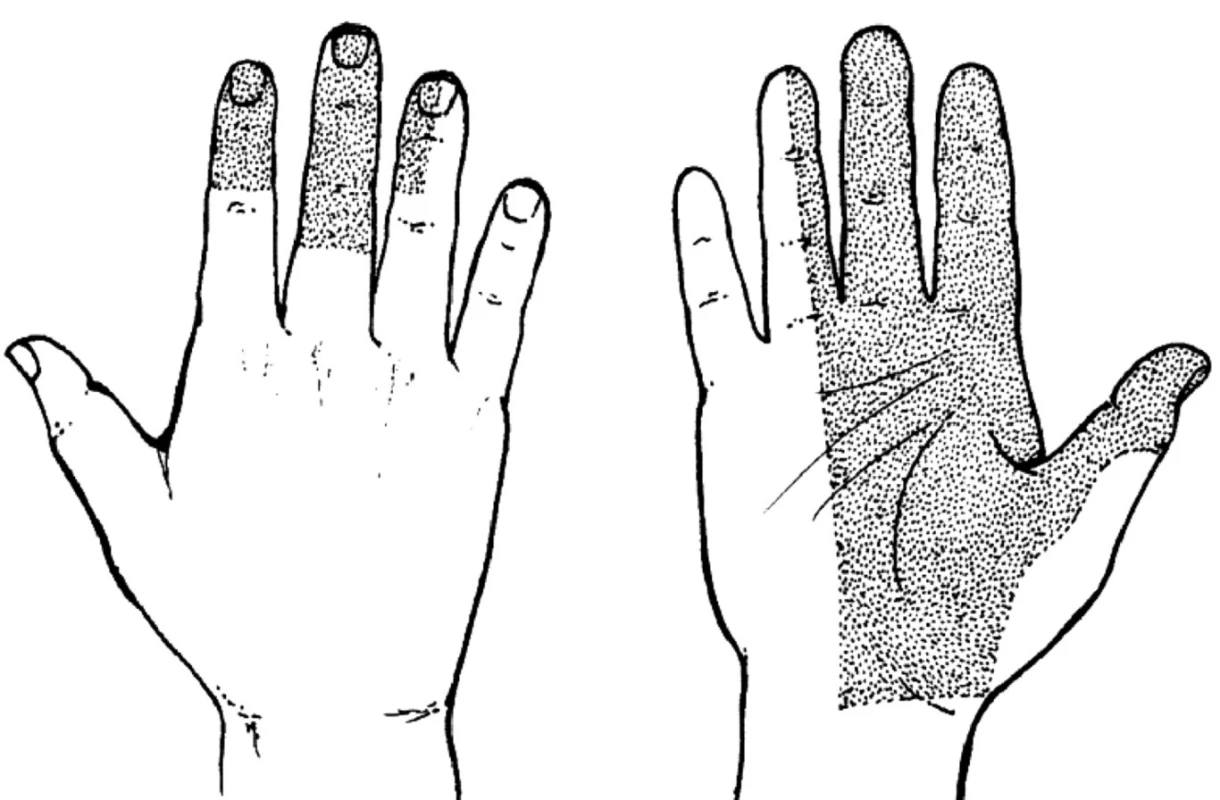 Syndrom karpálního tunelu – porucha čití.
Porucha čití na dlani a I.–III.prstu, radiální polovině IV. prstu a také dorzální plochy distálních dvou článků
II. až IV.prstu. Radiální část thenaru je inervována r. palmaris n. mediani.