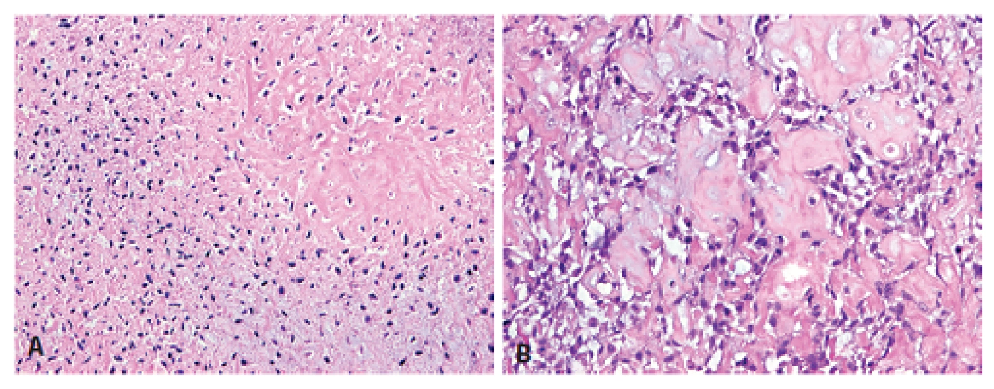 Způsob ukládání diskrétní amorfní obláčkovité osteoidní matrix, produkované málobuněčným mezenchymem mimo chondromatózní partie, se dosti lišil od vzhledu konvenčního OSA (HE; A -100x, B - 200x).
