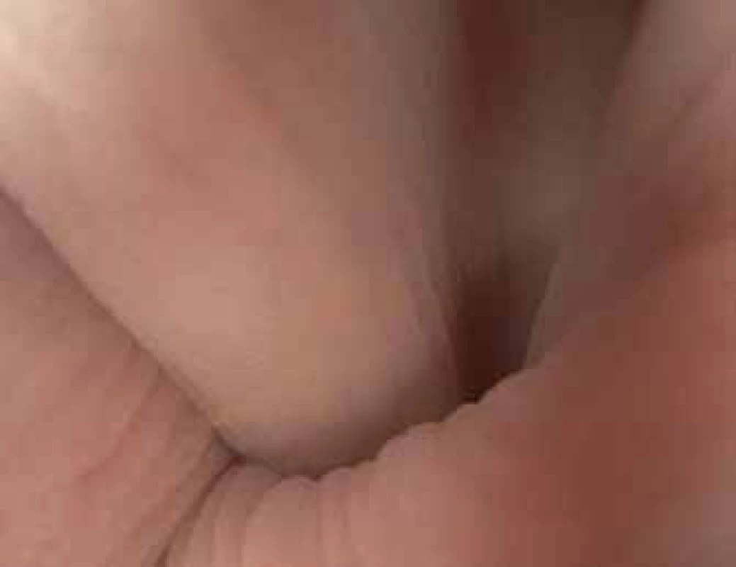 Volvulus sigmatu.
Fig. 5. Sigmoid volvulus.