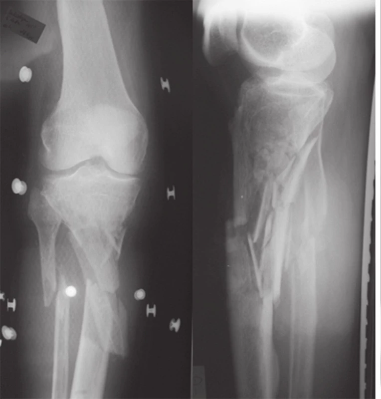 RTG natívne snímky – trieštivej defektnej metafyzárnej zlomeniny proximálnej časti pravej tíbie
Fig. 2: X-ray native scans – comminuted right tibial fracture with osseous metaphyseal bone defect