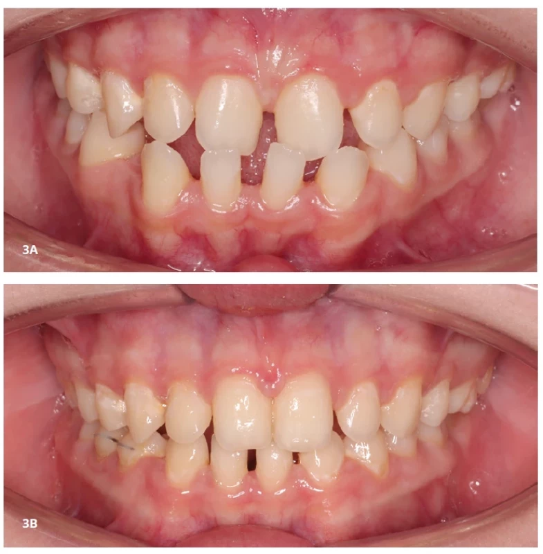 En-face fotografie chrupu ve skusu pacientky s Williamsovým-Beurenovým syndromem ve věku 12 let s agenezí zubů 31, 41 a obráceným skusem Fig. 3 En-face photograph of the dentition in occlusion of a 12-year-old female patient with Williams-Beuren syndrome with agenesis of teeth 31 and 41 and an anterior crossbite