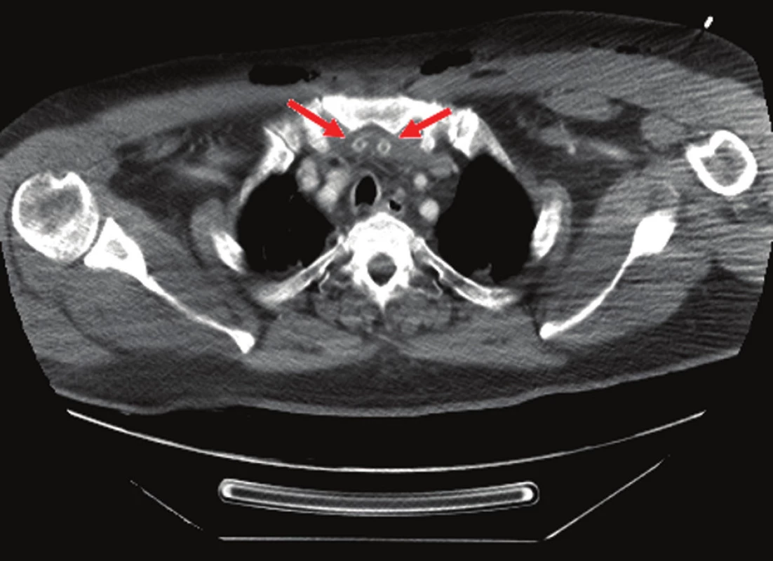 Retrosternální drenáž u sběhlé mediastinitidy, šipky ukazují uložené Redonovy drény
Fig. 6. Retrosternal drainage in mediastinitis, the arrows point at introduced Redon drains