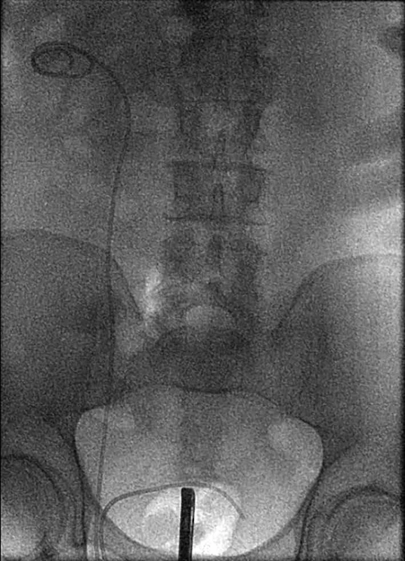 Urografia so zavedeným mono J stentom. </br> Fig. 2: Urography with an inserted mono J stent.