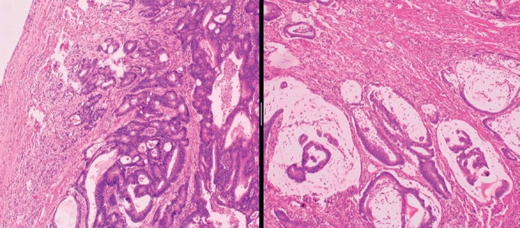 A) Tumour of the caecum. B) Tumour of the hepatic flexure. Both tumours show a histopathological picture of conventional adenocarcinoma. Irregular tubular and cribriform glands with central “dirty” necrosis (A). Pools of extracellular mucin present (B).