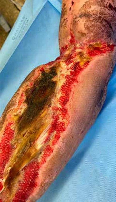Necrotizující fasciitis (masožravé bakterie). Bakteriální toxiny ničí kůži, svaly a další měkké tkáně.