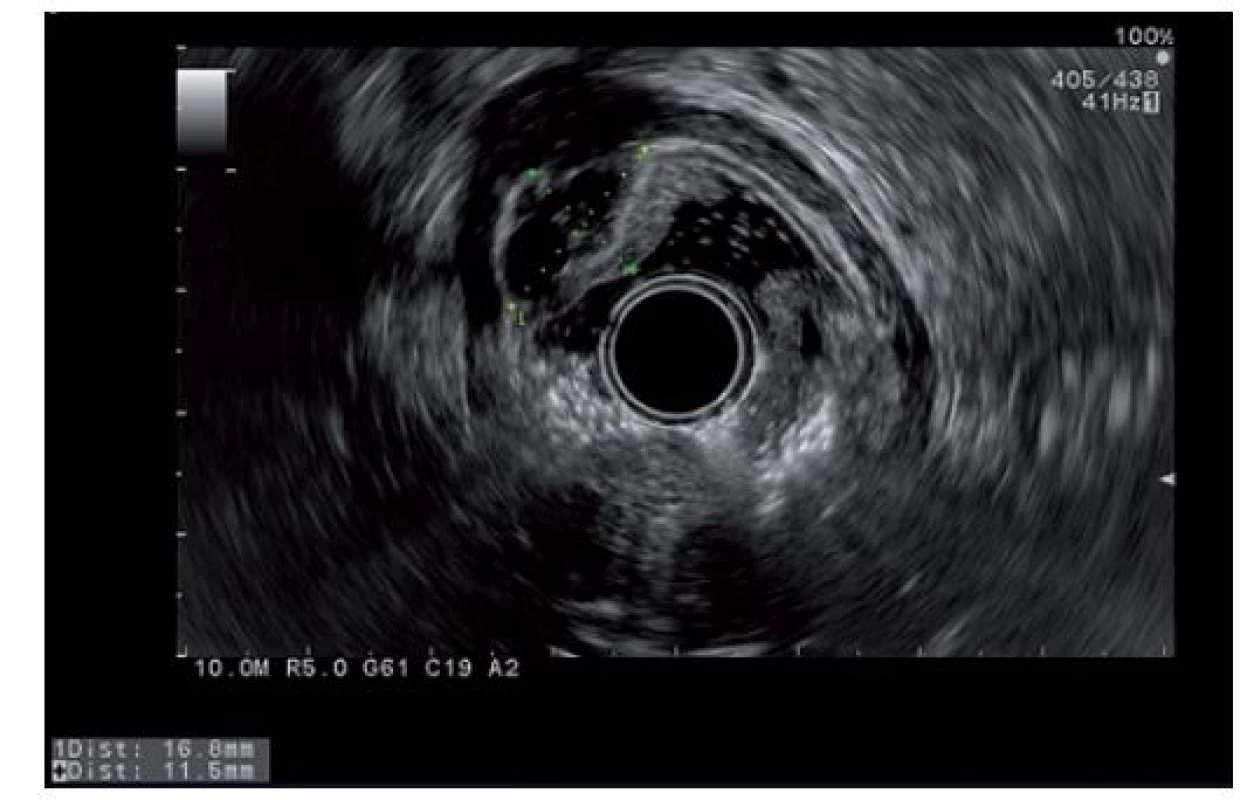 Endosonografický obraz antrálního útvaru žaludku.<br>
Fig. 2. Submucosal antral tumor in endosonographic imaging