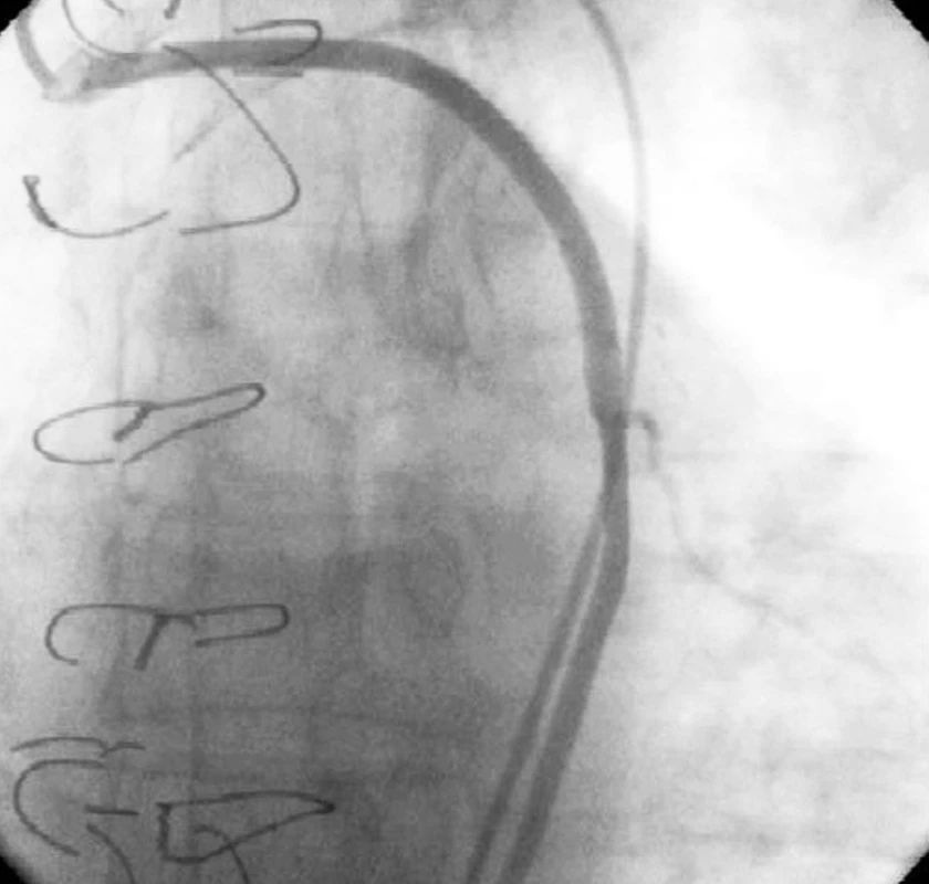 Prasklé drátěné kličky, dehiscence sterna, průchodný žilní bypass
Fig. 2. Broken wire loops, sternal dehiscence, unobstructed venous bypass