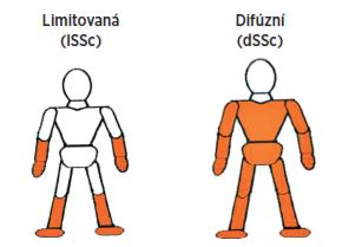 Formy systémové sklerodermie dle kožního postižení.