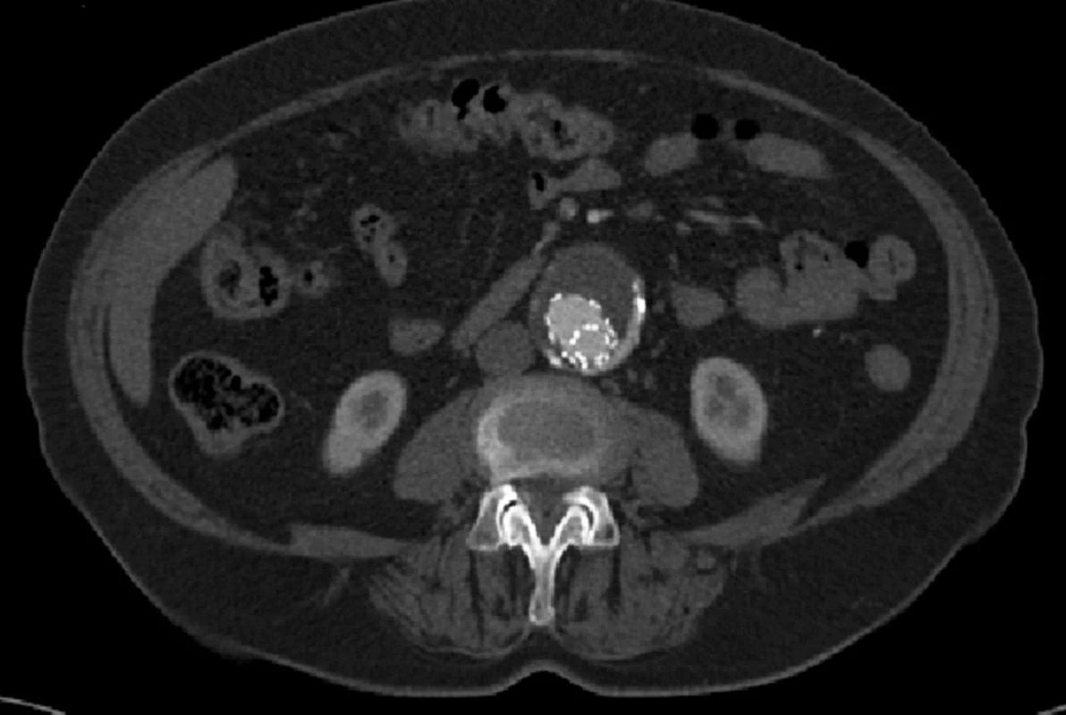 CTA obraz endoleaku III. typu
Fig. 15: CTA image type III endoleak