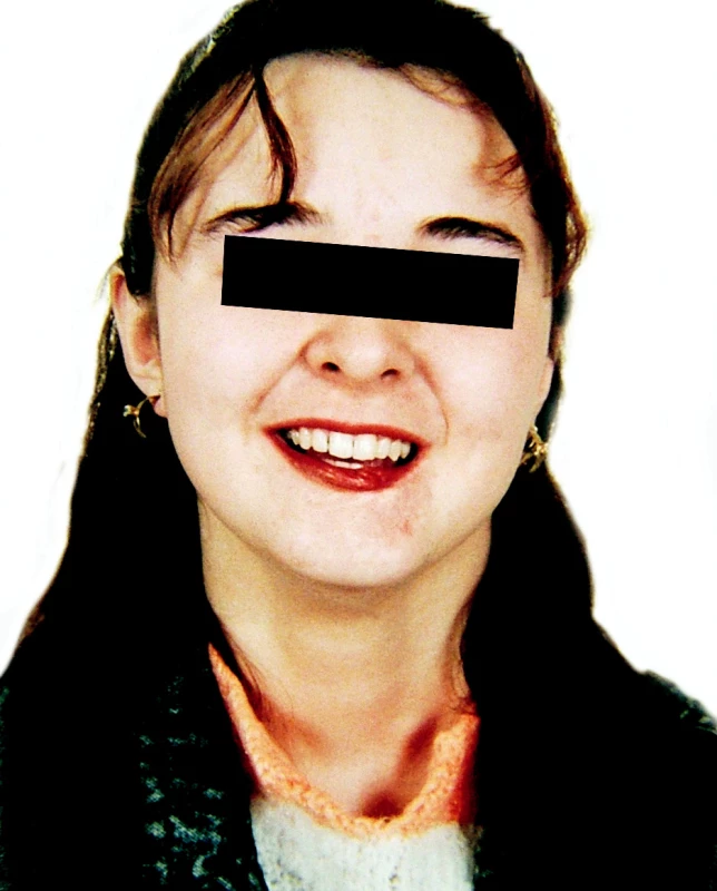 Ztrátové poranění dolního rtu (90 %) s odloženou rekonstrukcí
Pic. 2. A defect injury of the lower lip (90%) with delayed reconstruction