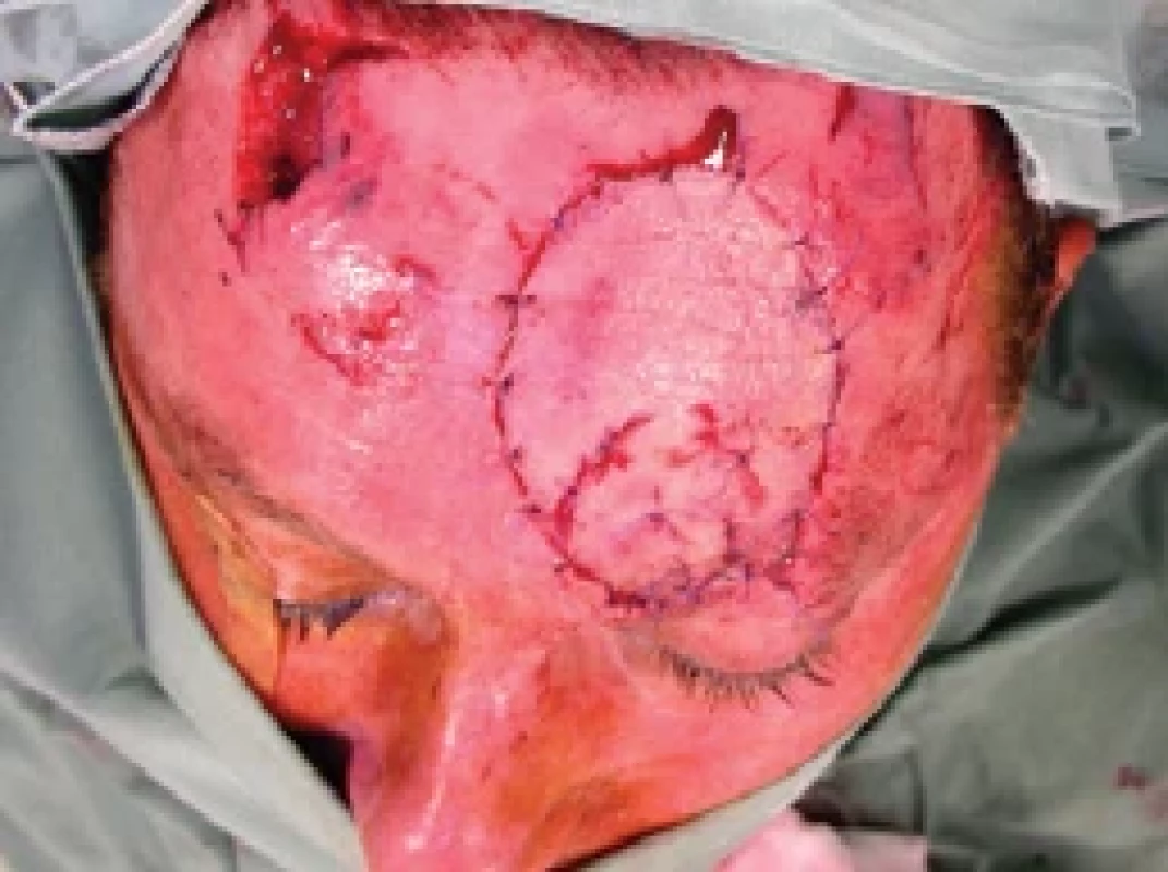 Vital fl ap after replantation. Source: archive of authors.