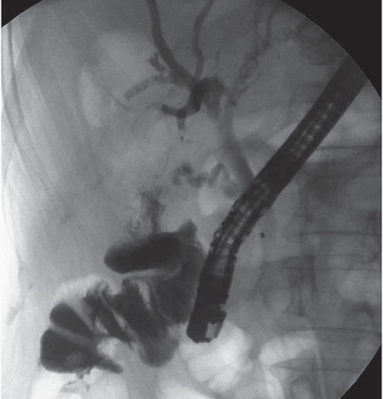 ERCP – kontrastní látka odtéká ze žlučových cest do tračníku.
Fig. 2. ERCP – contrast medium flowing away from the biliary system into colon.