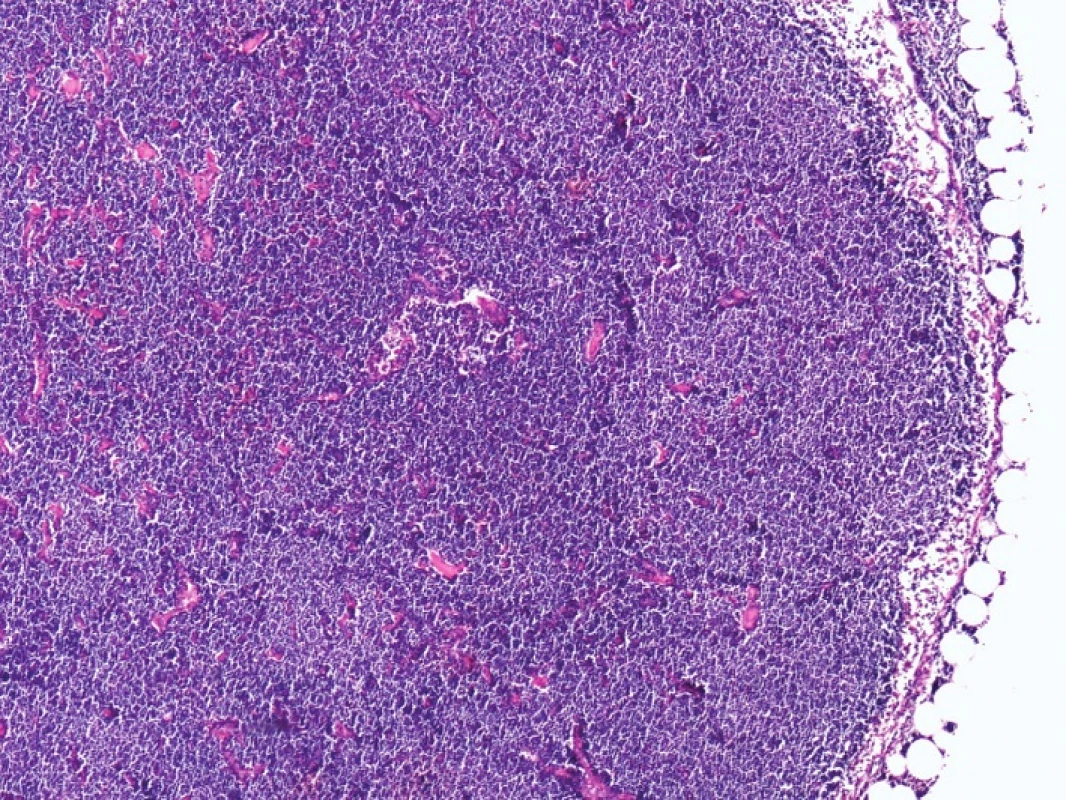 Kazuistika 2 – mízní uzlina s infiltrací malobuněčným B-lymfomem CLL/SLL, s lymfomovou infiltrací okolní tukové tkáně (HE, 10x)
Fig. 3: Case 2 – lymph node infiltrated by small cell B-cell lymphoma CLL/SLL, with lymphoma infiltration of the surrounding fat tissue (HE, 10x)