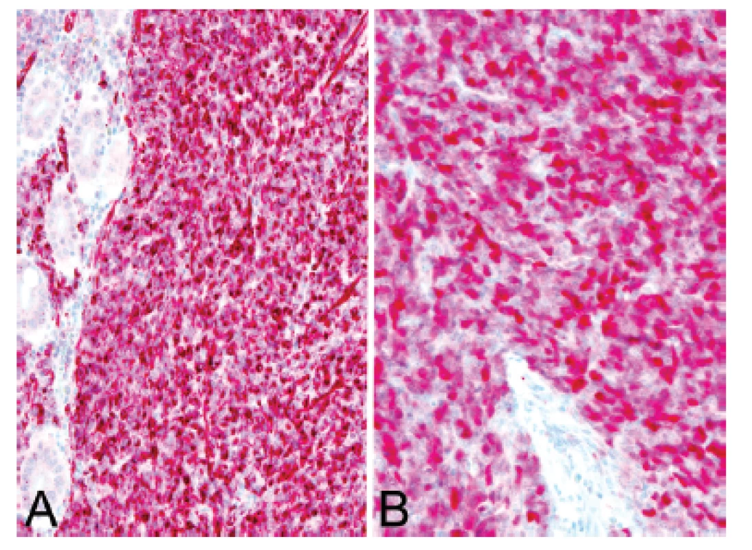 Kazuistika <b>1</b>. Difúzní silná cytoplazmatická pozitivita calretininu  <b>(A)</b> a nukleární exprese WT1 <b>(B)</b> v nádorových buňkách (IHC, 200x).