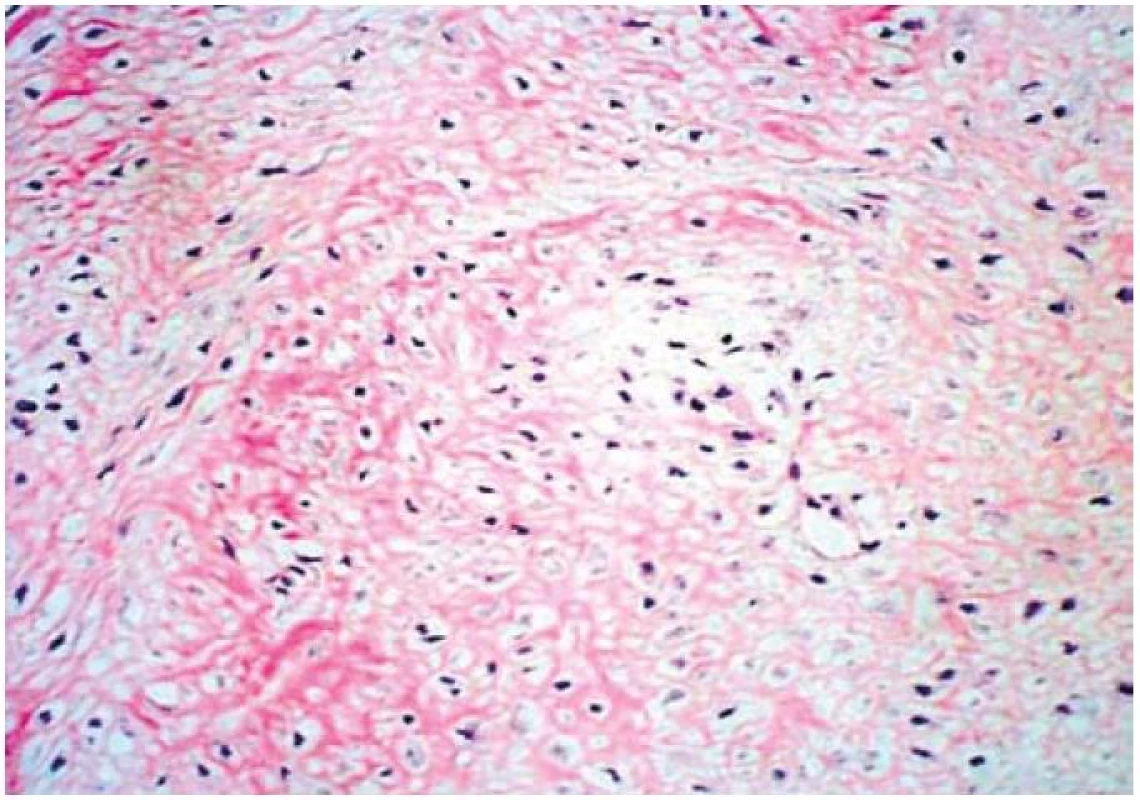 Histologický nález, farbivo hematoloxylin-eosin – neostro ohraničená, infiltratívna lézia s vretenovitými fibroblastami uloženými v kolagénnej stróme.
Fig. 3. Histological investigation suggested poorly demarcated infiltration with spindle fibroblasts on the collagenous tumour stroma (hematoxyline-eosine staining).