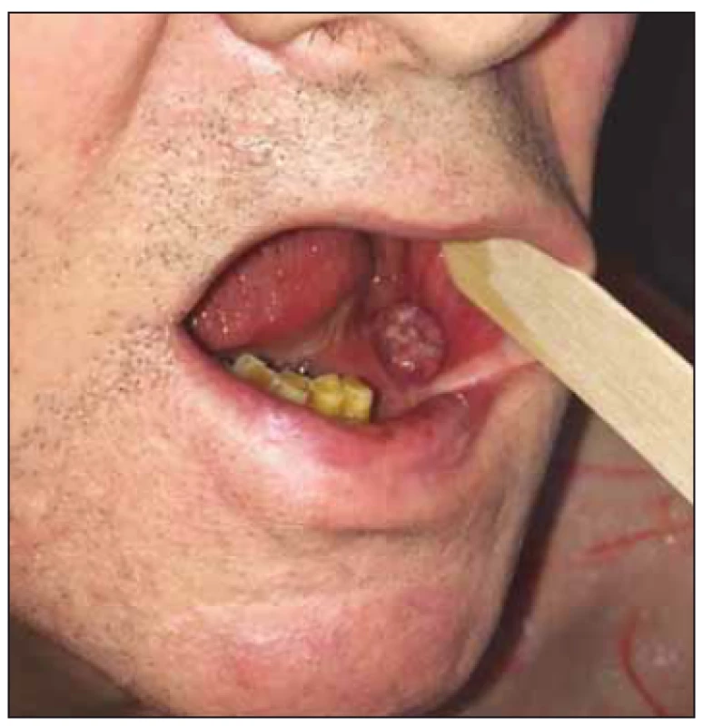 Velikost a lokalizace tumoru před
operací (pacient č. 1).<br>
Fig. 1. Size and location of the tumor before
surgery (patient No. 1).