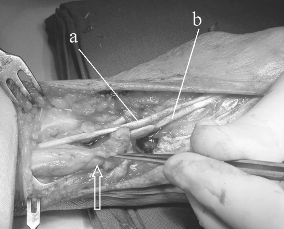 Operační nález synovitidy extenzorů: šipka ukazuje šlacha extenzorů prstů s masivní tenosynovitidou, a) m.extensor dig. II., b) m. extensor indicis proprius (obě šlachy bez
poškození.