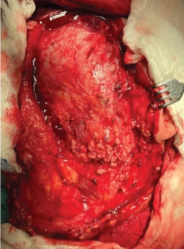 Modifi ed Blair approach to the tumor.