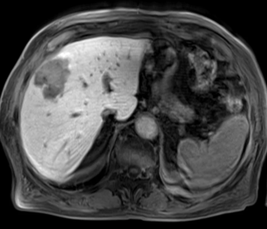 Nepravidelné expanzivní ložisko v pravém jaterním laloku – magnetická rezonance (T1).
Fig. 1: Transverse contrast-enhanced fat-suppressed T1- weighted gradient-echo image in the venous phase shows irregular expansive nodule in the right liver lobe.