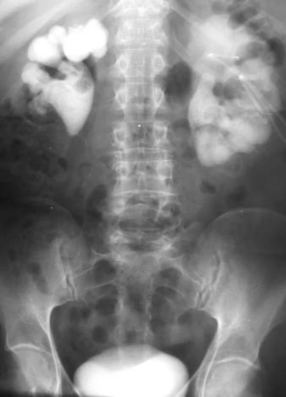 Týž snímek, intravenózní vylučovací urografie, hydronefróza.
