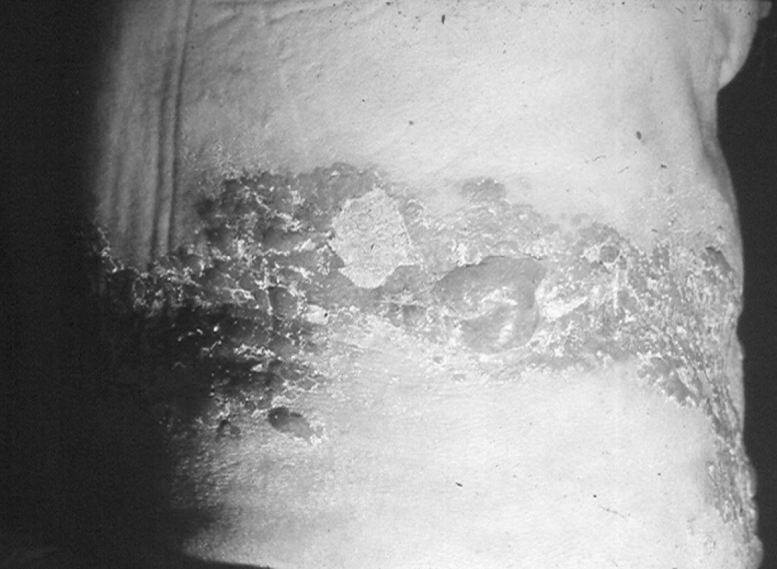 Vzhled bulózních eflorescencí u zoster thoracicus
Fig. 1. Bullous eruption in herpes zoster thoracicus