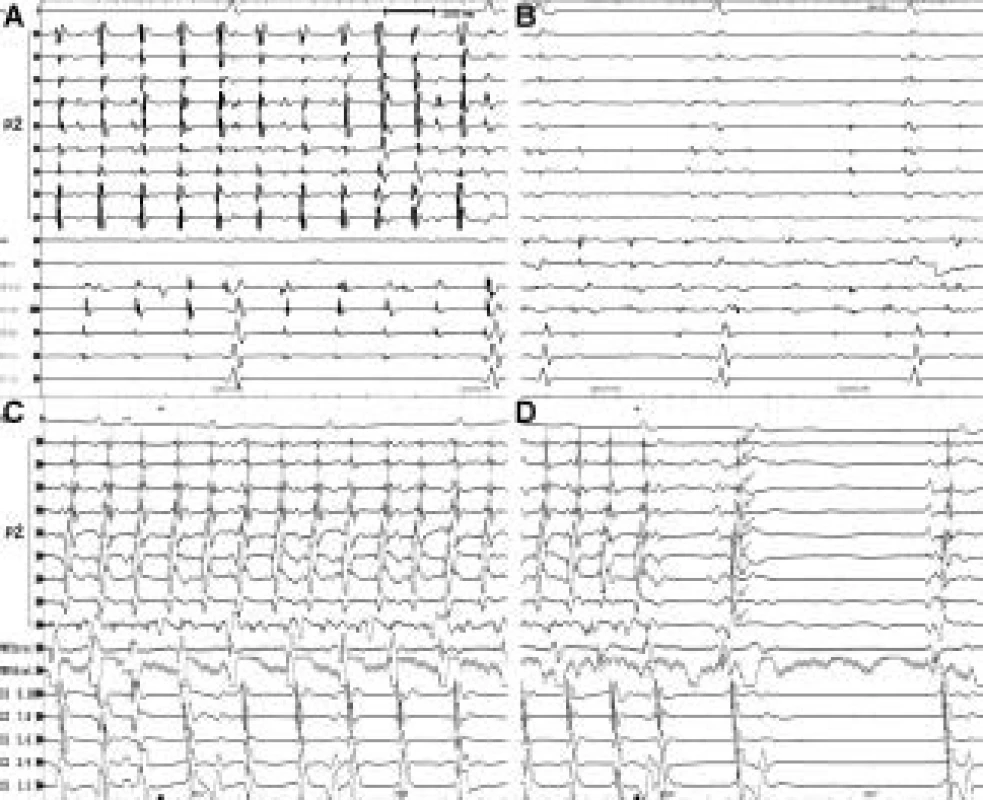 Izolace plicních žil v průběhu běžící fibrilace síní. Na obr. 3A je EKG záznam z plicní žíly před izolací plicní žíly. V plicní žíle jsou vidět ostré vysokofrekvenční potenciály o rychlé frekvenci, které reprezentují rychlou elektrickou aktivitu vycházející ze svaloviny plicních žil. Na obrázku 3B je stav po izolaci dotyčné plicní žíly, projevující se eliminací vysokofrekvenčních potenciálů a do záznamu se promítají pouze tupé („far field“) signály z levé srdeční síně. Skutečnost, že po izolaci plicní žíly fibrilace síní přetrvává, může znamenat, že uvedená plicní žíla neurčuje běh fibrilace síní, resp. není jedinou plicní žilou, která fibrilaci síní řídí. Na obr. 3C je záznam ukončení paroxyzmu fibrilace síní (trvajícího několik hodin) v průběhu izolace plicních žil. Těsně před ukončením běžící fibrilace je zjevné zpomalování elektrické aktivace jak v plicní žíle, tak i v levé síni a také relativní zpožďování aktivace v levé síni oproti aktivaci v plicní žíle. Z prvního sinusového stahu je zjevné, že izolace plicní žíly v okamžiku ukončení fibrilace síní není úplná, při sinusovém stahu šipky ukazují na pasivní elektrickou aktivaci myokardu plicní žíly (vysvětlení viz obr. 4). Ukončení fibrilace síní při izolaci plicní žíly znamená, že se jedná o jedinou arytmogenní plicní žílu nebo jednu z více aktuálně arytmogenních plicních žil, která byla postupně izolována jako poslední v pořadí.

